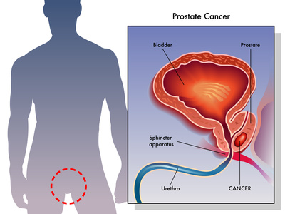 prostate cancer