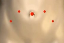 robotic hysterectomy incisions