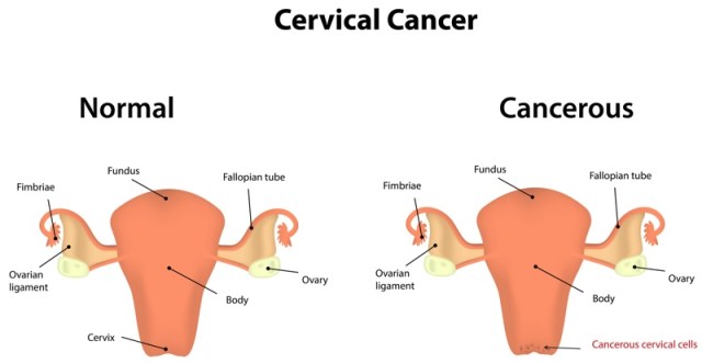 cervical cancer screening