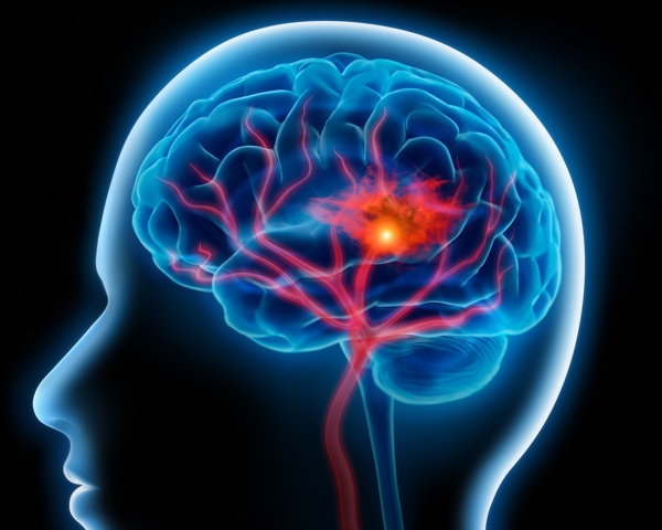 stroke early symptoms